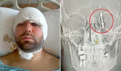 Bursa’da inanılmaz olay: Diş doktoru vidayı beynine sapladı!